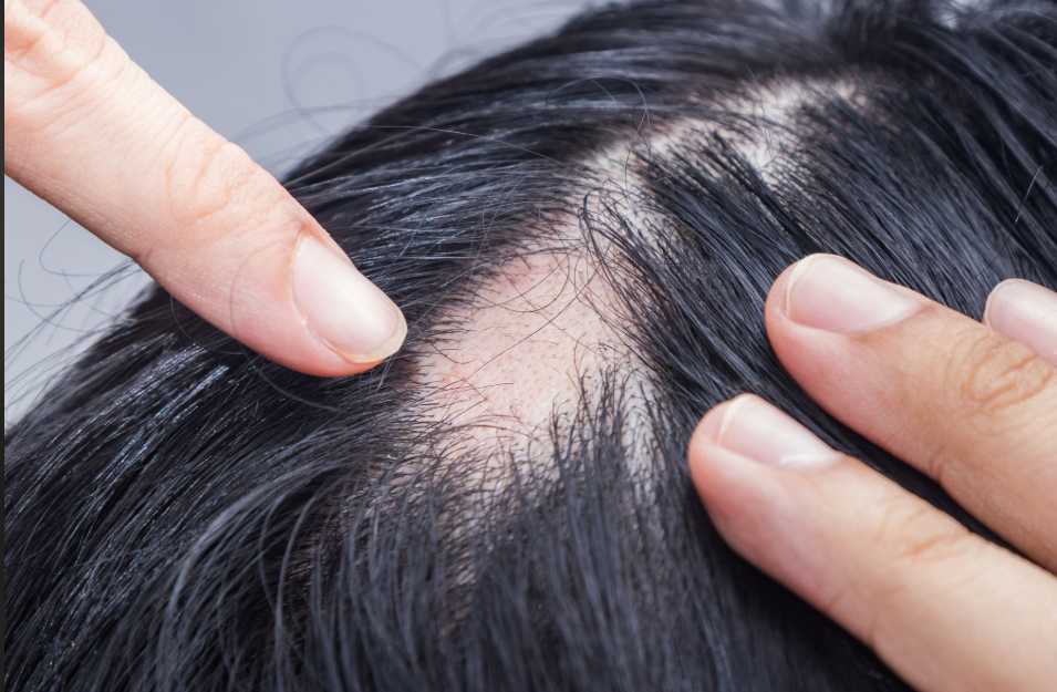 alopecia